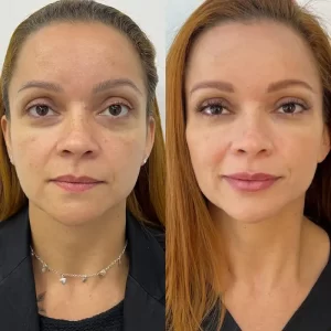 como e feita a harmonização facial