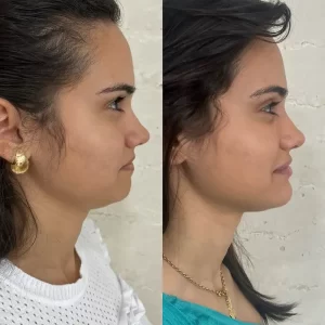 harmonização facial em Brasília