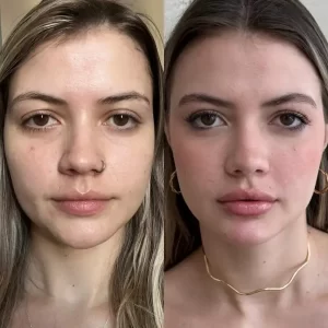 harmonização facial em jovens