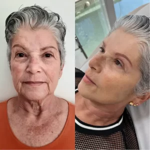 harmonização facial em senhora